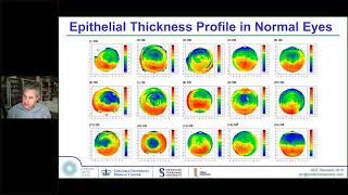 Laser Eye Surgery – Wavefront Guided Wavefront Optimised SMILE vs LASIK vs TransPRK vs ICL [upl. by Dirk]