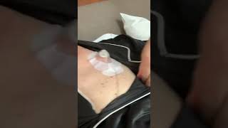 Chemo 46hour Fluorouacil drip infused at home after inhospital Folfirinox infusion [upl. by Ahcsim]