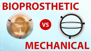 Mechanical or Bioprosthetic Heart Valves Which Is Best For You [upl. by Atinram]