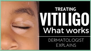 Vitiligo a breakthrough therapy  The introduction of SCENESSE® in vitiligo treatment [upl. by Pevzner]