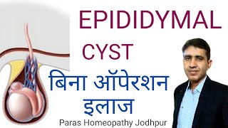 अंडकोष में गांठ  Epididymal Cyst  बिना ऑपरेशन इलाज  Homeopathic Treatment for Epididymal Cyst [upl. by Ettedanreb275]