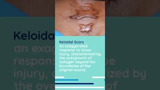 What type of ACNE SCARS do YOU SUFFER from 1million viral acnescars [upl. by Raf]