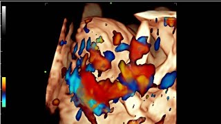 chorioangioma with hyperdynamic circulation fetal ultrasound [upl. by Sigismondo]