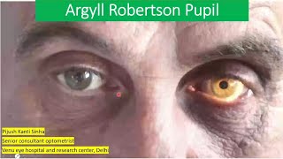 Pupil abnormality series lecture 4  Agryll robertson pupil VS adies tonic pupil [upl. by Wojak344]