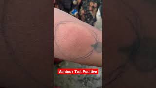 Mantoux Test Result Positive shortsyoutubeshorts virulshorts [upl. by Jallier]