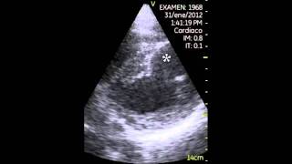 VSCAN Left ventricular aneurysm Aneurisma de ventrículo izquierdo [upl. by Schlessel108]