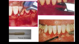 Gingivectomy amp Gingivoplasty [upl. by Nort398]