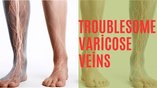 Troublesome Varicose Veins [upl. by Eloken947]