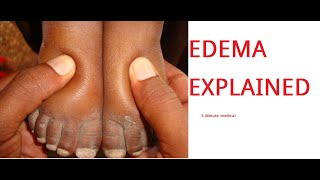 Edema Causes Pathophysiology Examination [upl. by Politi]