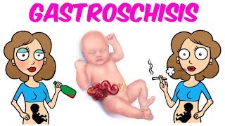 Gastroschisis [upl. by Cheffetz]