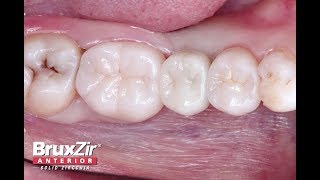 Chairside Live Episode 223 Protocol for SingleTooth Implant Placement [upl. by Anneuq]