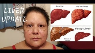 Liver Update  Cancer Vlog [upl. by Mariejeanne]