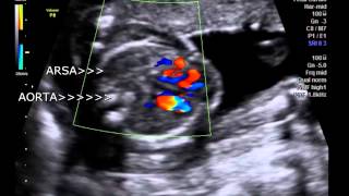 ARSA  aberrant Right subclavian artery in fetus 18 weeks [upl. by Elrak982]