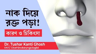 নাক দিয়ে রক্ত পড়ার কারণ ও এর চিকিৎসা II Nose bleeds causes and treatment in bengali [upl. by Martres]