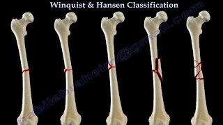 Fractures Of The Femur Shaft Winquist amp Hansen  Everything You Need To Know  Dr Nabil Ebraheim [upl. by Reilamag]