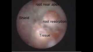 External Root Resorption 2 Viewed with the Perioscope [upl. by Nylyoj]