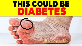 ALERT 18 SIGNS of DIABETES on THE SKIN that FEW PEOPLE KNOW  110 [upl. by Eceertal831]