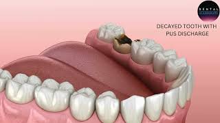 Root Canal Treatment Save Your Tooth and Stop Infection [upl. by Zippora40]