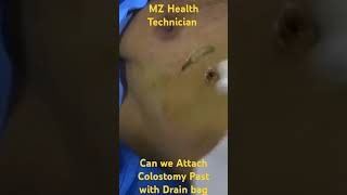 Can we Attach Colostomy Paste with Drain bag hospital ispaghol medicalequipment pulpotomy [upl. by Nodlew724]