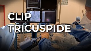 Clip Tricuspide [upl. by Elyn50]