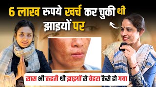 सास भी कहती थी झाइयों से चेहरा कैसा हो गया है  How to treat Pigmentation  Dr Upasana Vohra [upl. by Atisusej]