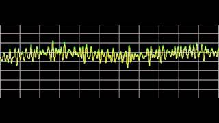 Hemangioma  Rife Frequencies [upl. by Adnola877]