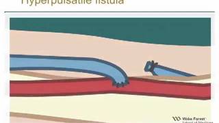 Physical Examination of Arteriovenous Fistula [upl. by Henryk]