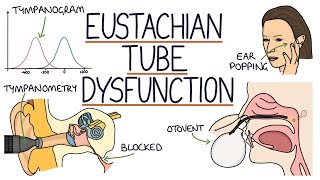 Understanding Eustachian Tube Dysfunction [upl. by Atelra365]