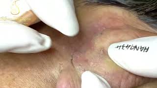 Loan Nguyen Acne Treatment 14411 [upl. by Vasily]