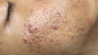 ACNE TREATMENT VU QUYNH MI  Perennial Blackheads On Boy Face 2024FULL [upl. by Adnoyek814]