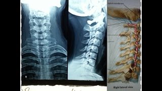 Cervical Spine X Ray and 3D Anatomy  Case of Cervical quotStraighteningquot [upl. by Anahsirk258]