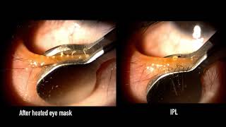 Meibomian gland expression differences with and without IPL [upl. by Etakyram364]