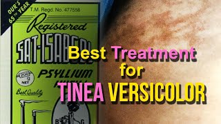 Effective Treatment for Tinea  Pityriasis Versicolor Skin Fungus  Psyllium Husk  Natural Remedy [upl. by Ilil]