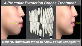 Changes in Face After 4 1st Premolars Extraction amp Braces Treatment Best HD Animation  Dr Ram MDS [upl. by Dorin]