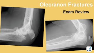 Olecranon Fractures  Joaquin SanchezSotelo MD [upl. by Gilligan]