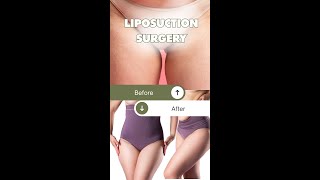 Thigh Liposuction Surgery Live Steps  Dr Ashutosh Shah  Elegance Clinic  Surat [upl. by Neo290]