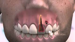 How to treat a dental Fistula [upl. by Walrath]