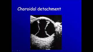 Ophthalmic ultrasonography 4 choroidal detachment [upl. by Etteiluj]