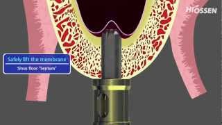 OSSTEM  HIOSSEN CASKit Crestal Approach Sinus Kit [upl. by Nissy]