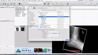 How to import DICOM and JPEGs into OsiriX Lite [upl. by Enihpad]