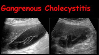 Gangrenous Cholecystitis [upl. by Eyllom]