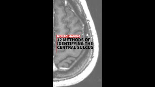 12 methods to identify the central sulcus [upl. by Ledarf]