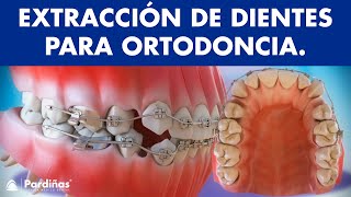 Extracción de dientes en ortodoncia © [upl. by Omolhs]