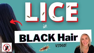 Lice and Nits in Black Hair [upl. by Gawain509]