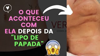 Tratamento de fibroses pós lipo de quotPapadaquot O que aconteceu com ela e o que fazer nesse caso [upl. by Nhguahs969]