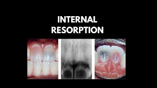 internal resorption of teeth  BDS endodontics dental world dentist [upl. by Anneirb]