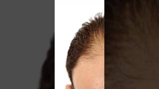 Alopeciacausesmedicine health mbbs healthtips ytshorts mbbs [upl. by Ynomrah]