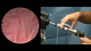 Camera optics TURP Prostate surgical procedure [upl. by Rihat719]