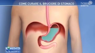 Come curare il bruciore di stomaco [upl. by Starobin]