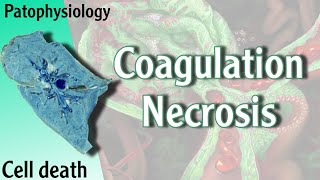 Pathophysiology  Coagulation Necrosis Hani Laith شرح [upl. by Aihsemak]